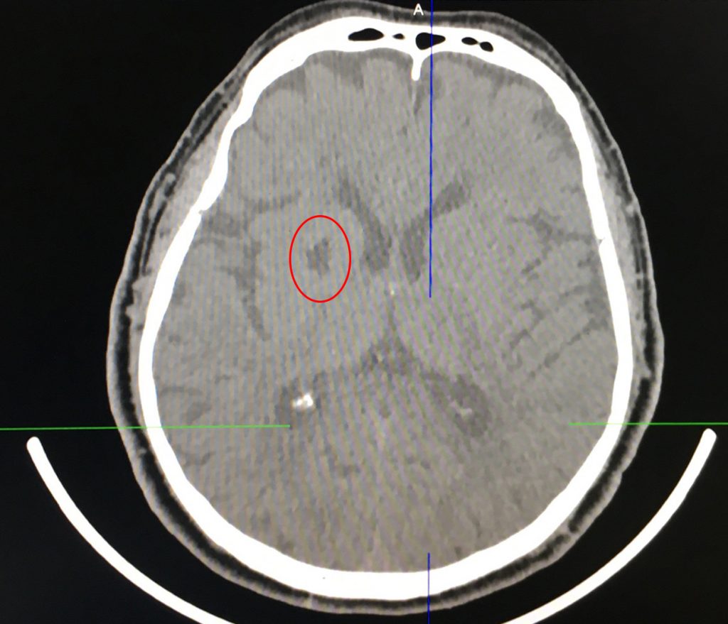 Hình ảnh chụp CT 160 lát của bệnh nhân.