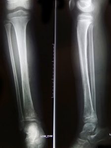 Hình chụp X-Quang cẳng chân phải của bệnh nhân trước khi phẫu thuật. 