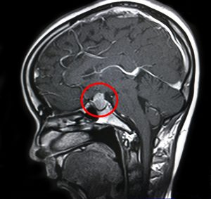 Ảnh chụp MRI 1.5 Tesla: khối u tuyến yên của bệnh nhân.
