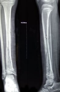 Hình chụp X-Quang cẳng chân phải của bệnh nhân sau khi phẫu thuật. 