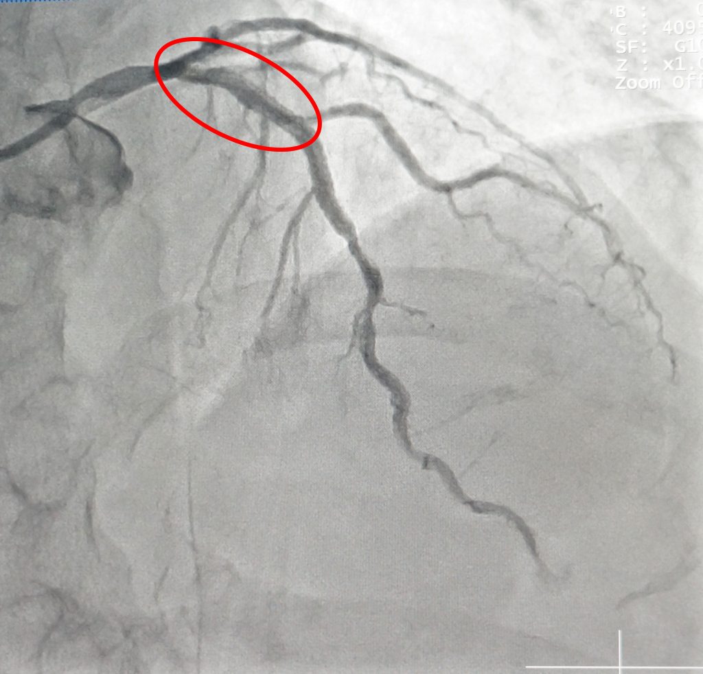 Động mạch vành bên trái hoạt động bình thường - không còn bị tắt sau khi can thiệp.