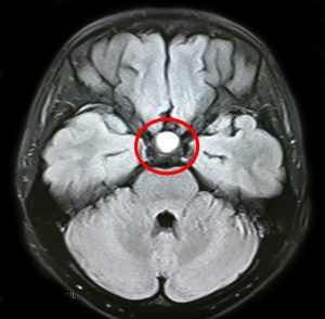 Ảnh chụp MRI 1.5 Tesla: khối u tuyến yên của bệnh nhân.