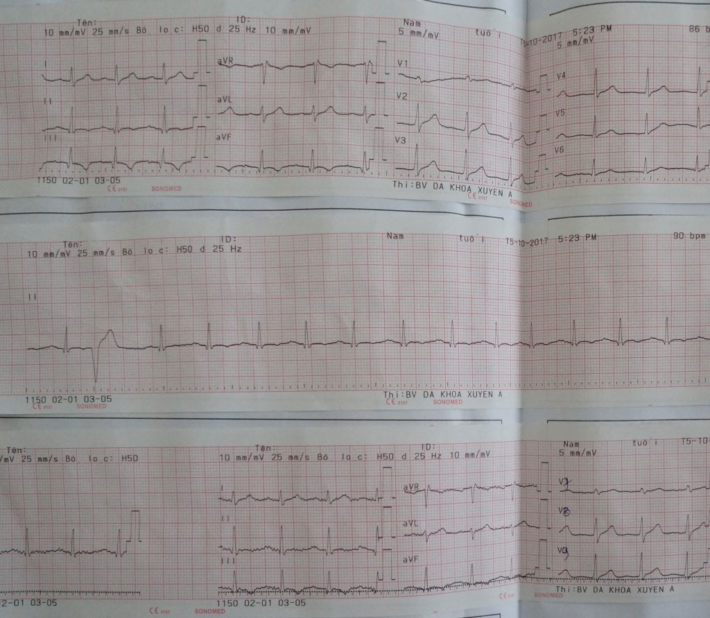 Sau can thiệp tim mạch, điện tim của bệnh nhân trở lại bình thường - không có dấu hiệu suy tim 