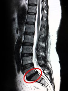 Ảnh chụp MRI bệnh nhân bị trượt cột sống thắt lưng