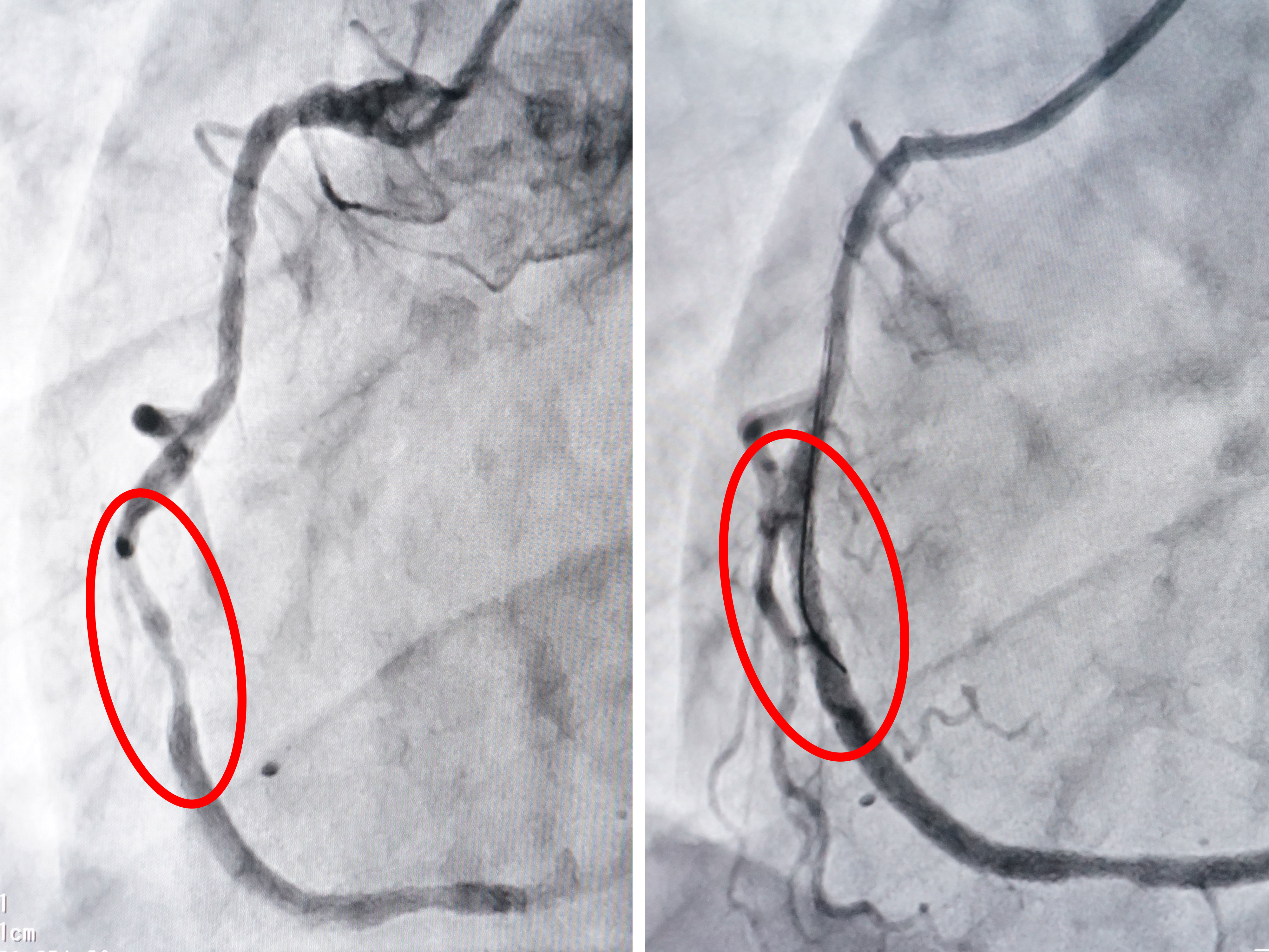 Hình chụp DSA: Đoạn mạch vành bị hẹp trước và sau khi được xử lý can thiệp.