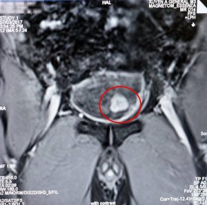 Ảnh MRI 1.5 Tesla: khối u xâm lấn qua lớp cơ bàng quang.