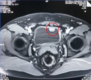 Ảnh MRI 1.5 Tesla: khối u xâm lấn qua lớp cơ bàng quang.