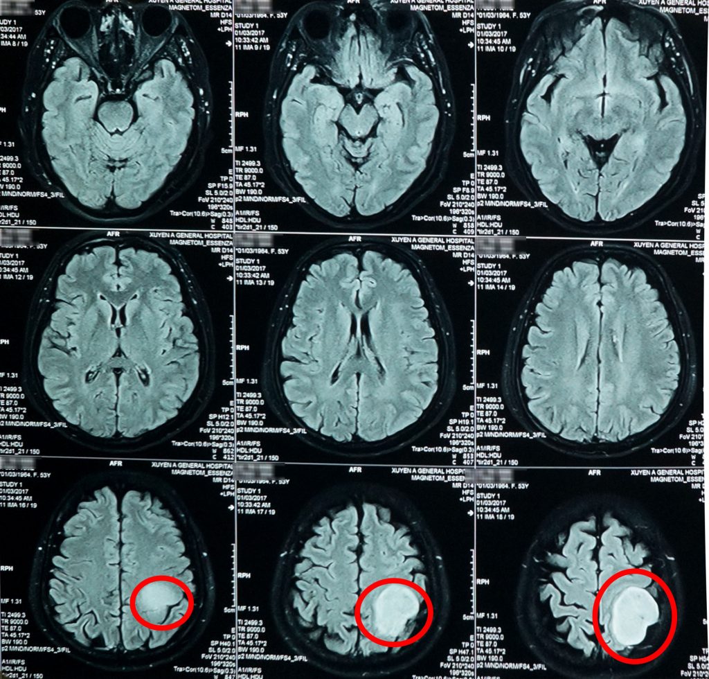 Ảnh chụp MRI 1.5 Tesla cho thấy khối u lớn, đường kính 5cm trong não bệnh nhân.