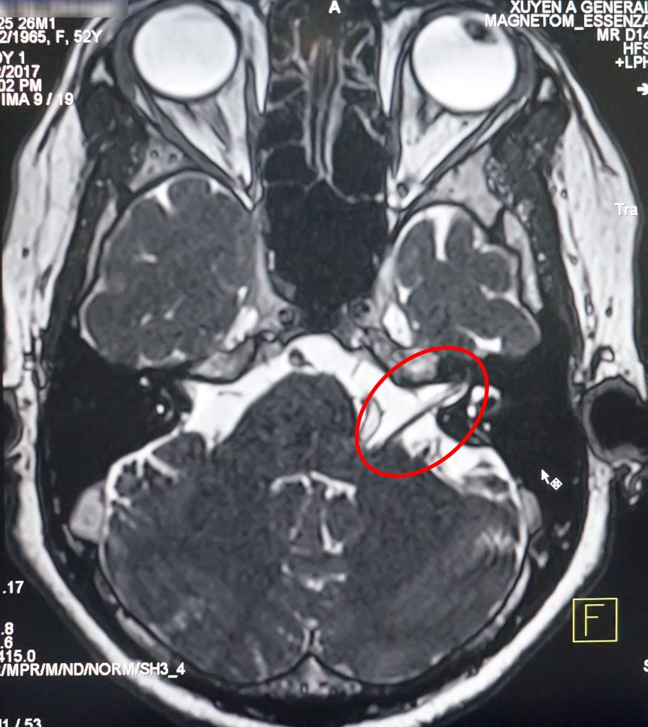 Hình ảnh chụp cộng hưởng từ MRI 1.5 Tesla: dây thần kinh VII bị chèn ép.