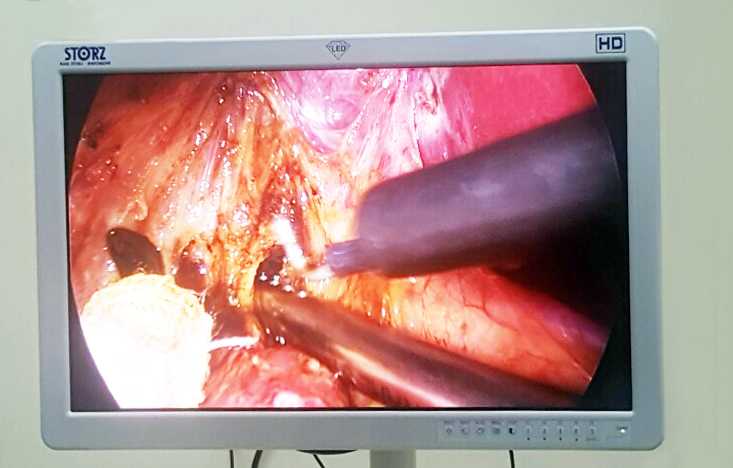 Hình ảnh trên màn hình máy phẫu thuật nội soi.