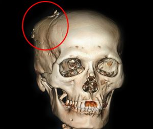 Ành CT 160 lát dựng 3D: sọ não bệnh nhân nứt vỡ do bị chém. 