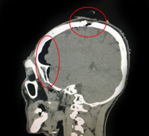 Ảnh CT 160 lát: bệnh nhân bị thương tổn nứt sọ thái dương vùng đính bên phải, tụ khí bên phải nhiều hơn bên trái 