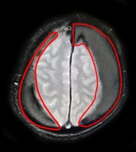 Ảnh chụp MRI 1.5 Tesla: bệnh nhân N.H. bị máu tụ dưới màng cứng lượng nhiều ở 2 bên bán cầu gây chèn ép não. 