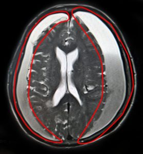 Ảnh chụp MRI 1.5 Tesla: bệnh nhân V.T. bị máu tụ dưới màng cứng lượng nhiều ở 2 bên bán cầu gây chèn ép não.