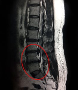 Ảnh chụp MRI 1.5 Tesla (T1-sag): Bệnh nhân bị thoát vị đĩa đệm 3 tầng và hẹp ống sống 