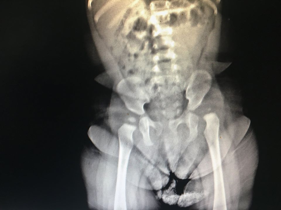 Ảnh chụp XQ của bé N. 11 tháng tuổi bị trật khớp háng (T) bẩm sinh