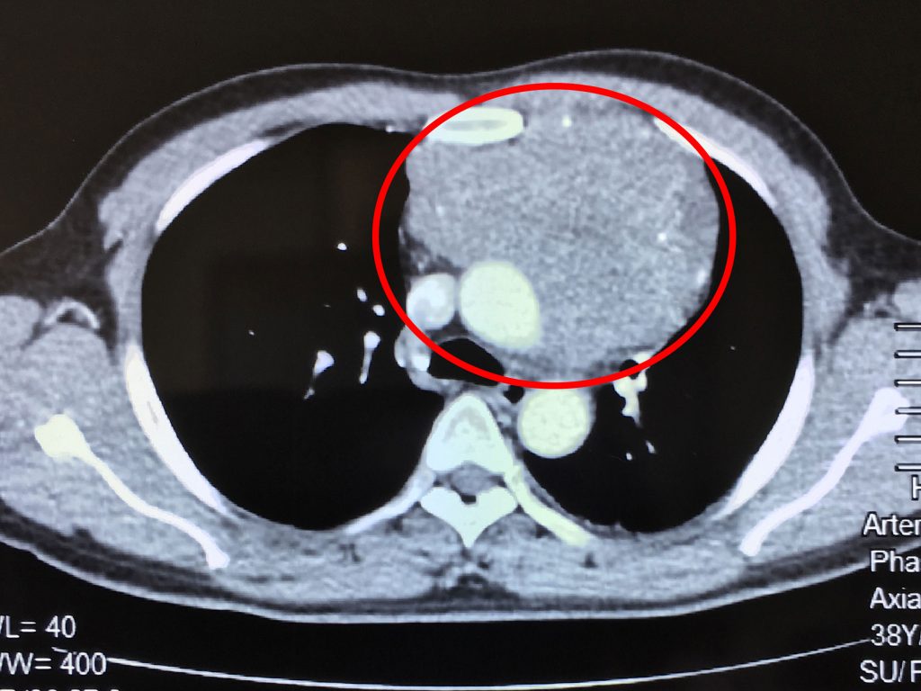 Hình chụp cắt lớp vi tính (CT) 160 lát: khối u xuất phát từ trung thất trước, xâm lấn rộng vào màng ngoài tim, tĩnh mạch vô danh, thần kinh hoành bên trái, động mạch phổi và lan ra sau dính vào động mạch chủ ngực xuống. 