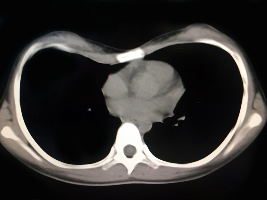 Ảnh chụp cắt lớp vi tính CT 4 lát thể hiện tình trạng ngực lõm của bệnh nhân. 