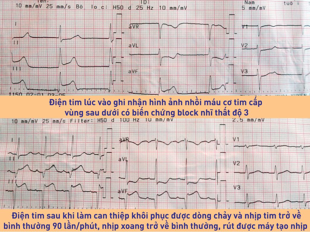 Điện tim ghi nhận trước và sau khi bệnh nhân được can thiệp