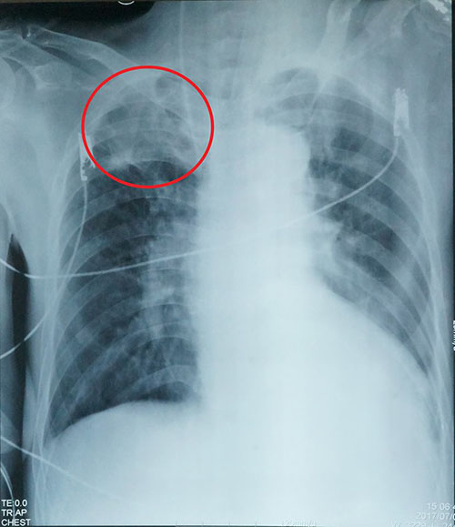 Ảnh XQuang của bệnh nhân với phần phổi bị u nấm.