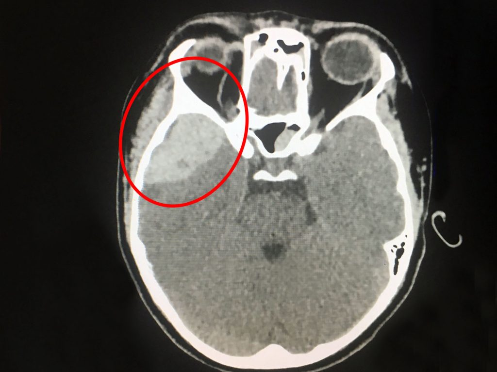 Ảnh chụp CT Scanner 160 lát sọ não cho thấy bệnh nhân bị máu tụ ngoài màng cứng hố thái dương phải.
