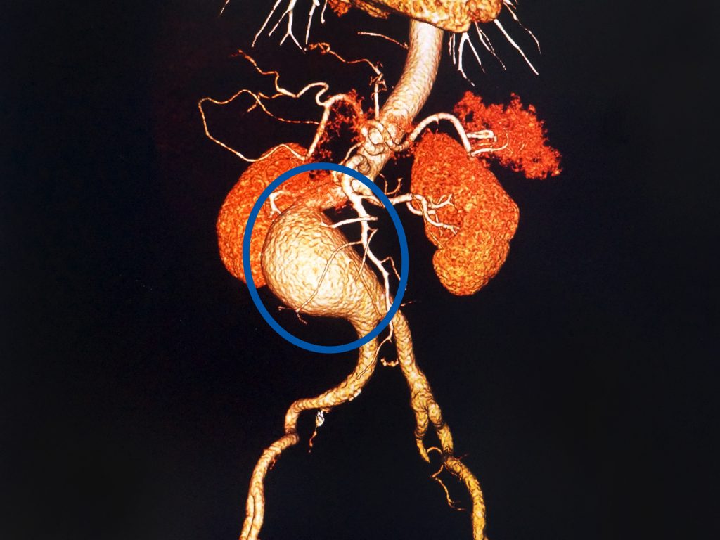 Ảnh cắt lát vi tính (CT) dựng 3D - động mạch chủ bụng bị phình to gần bằng quả thận của bệnh nhân