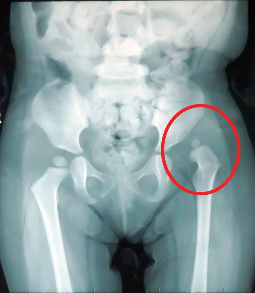 Ảnh X-quang của bệnh nhi, bé bị trật khớp háng bẩm sinh bên trái.