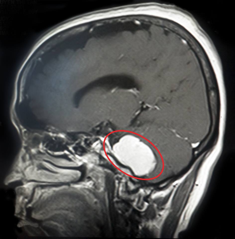 Hình ảnh MRI khối u não.