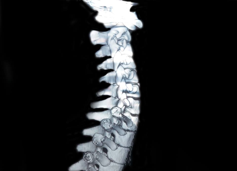 Hình ảnh chụp cắt lát vi tính (CT) cột sống của bệnh nhân.