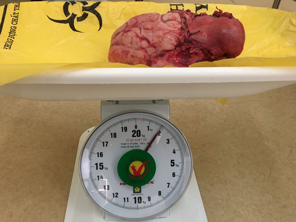 Khối u xơ tử cung nặng 2 kg được lấy ra khỏi bụng bệnh nhânc