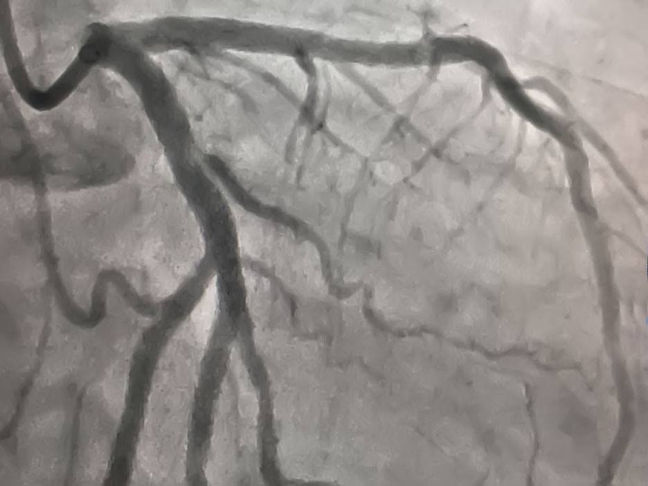 Ảnh chụp mạch vành sau can thiệp mạch vành cho bệnh nhân