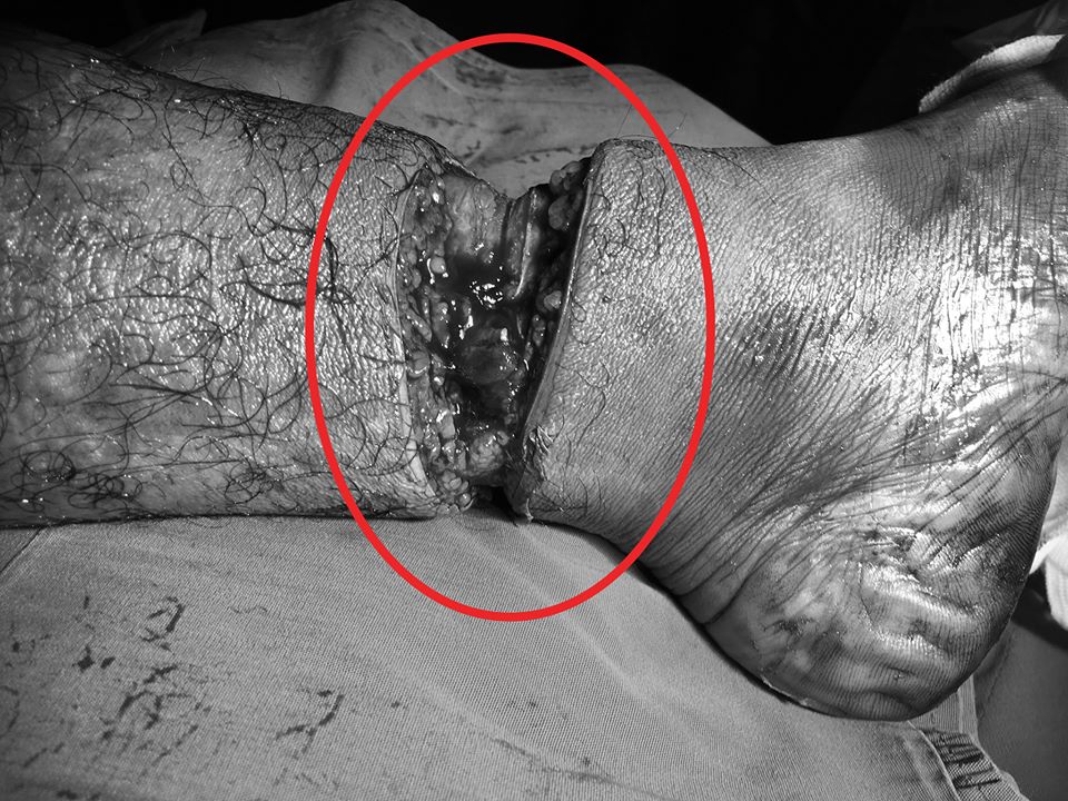 Ảnh chụp cẳng chân bệnh nhân sau tai nạn lao động