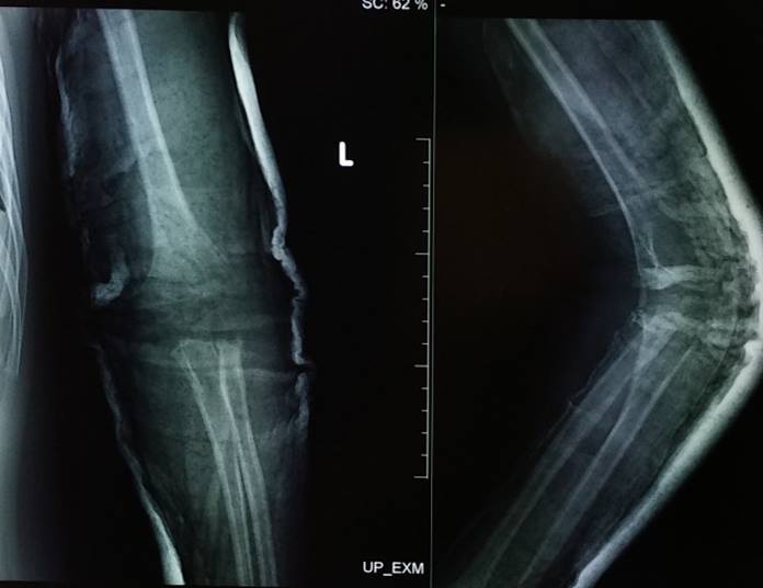 Ảnh X-quang chụp khuỷu tay trái.
