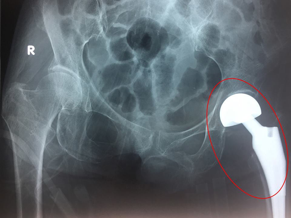 Ảnh chụp phim X - quang cổ xương đùi bệnh nhân sau phẫu thuật.