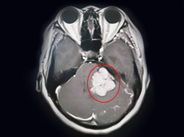 Ảnh chụp cộng hưởng từ (MRI) khối u não lớn, ở vị trí khó.