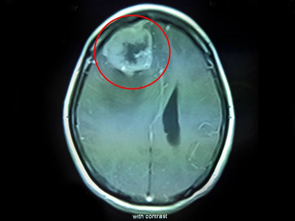 Kết quả chụp MRI Tesla 1.5 kiểm tra bệnh nhân có khối u màng não rất lớn ở vùng trán phải