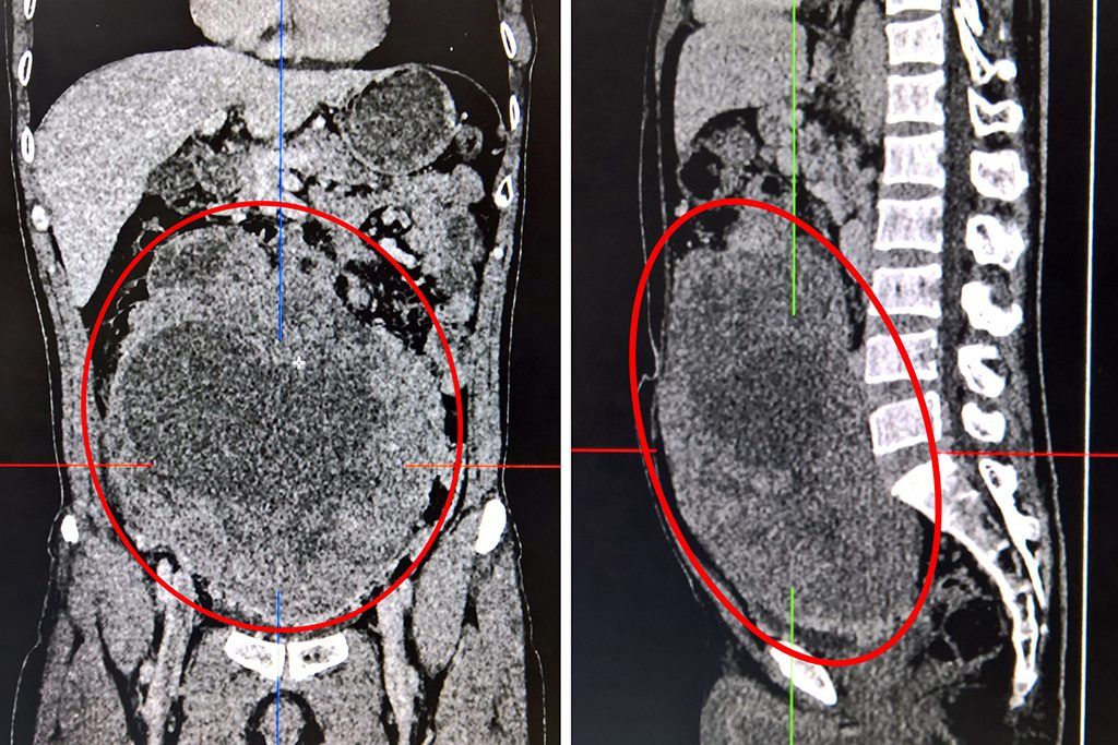 Ảnh chụp cắt lát vi tính CT 160 lát khối u ổ bụng của bệnh nhân có kích thước lớn.
