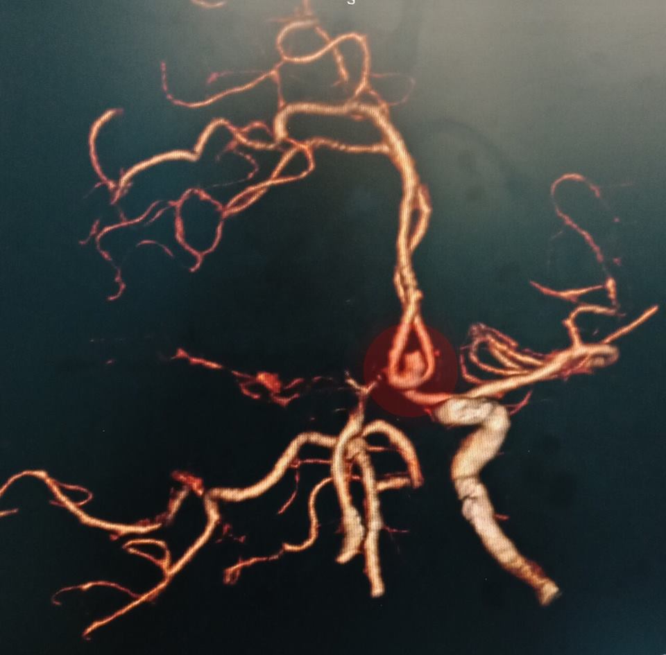 Ảnh chụp CT scan 160 lát cắt dựng hình mạch máu não 3D của bệnh nhân
