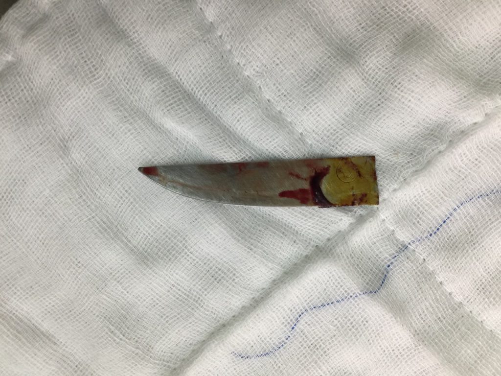 Ảnh lưỡi dao được rút ra khỏi người bệnh nhân.