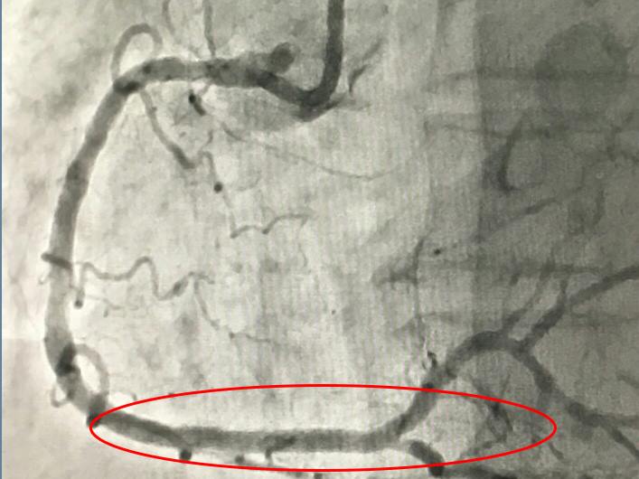 Ảnh chụp mạch sau khi đặt stent tái thông hoàn toàn mạch máu vành phải của bệnh nhân