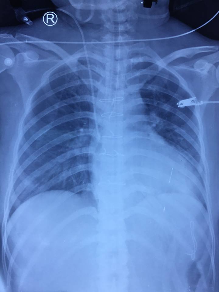 Hình X-quang sau mổ.