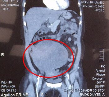 Hình chụp CT u buồng trứng. 