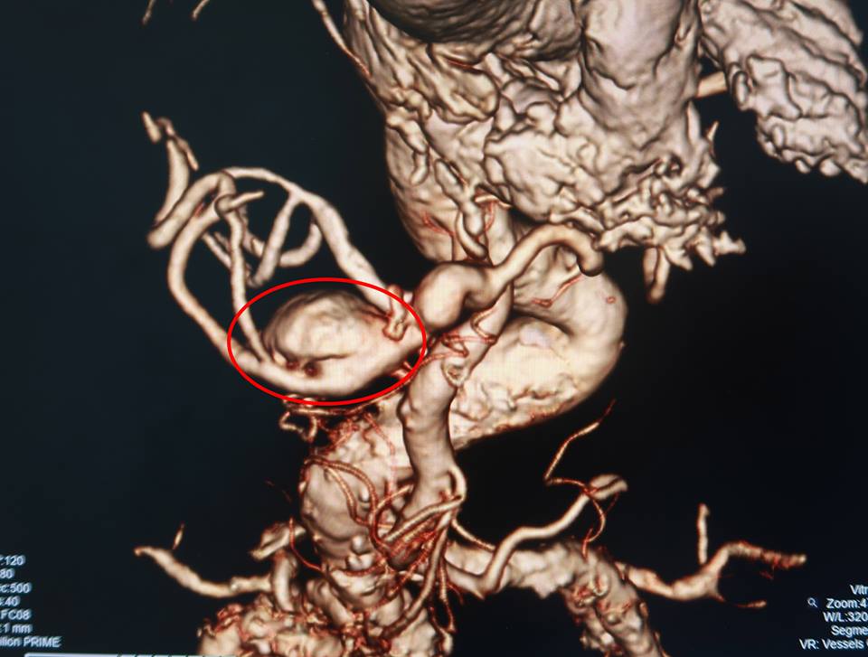 Ảnh chụp CT-Scan túi phình động mạch gan có dựng 3D.