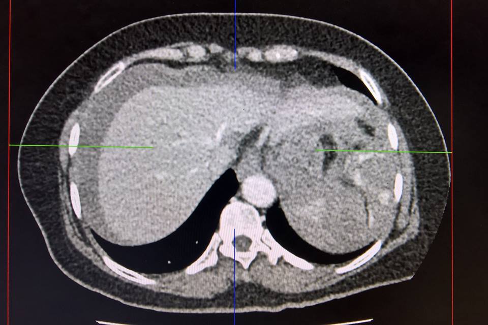 Ảnh chụp CT 160 lát cắt: bệnh nhân bị chấn thương vỡ lá lách, chảy máu lượng nhiều trong ổ bụng.