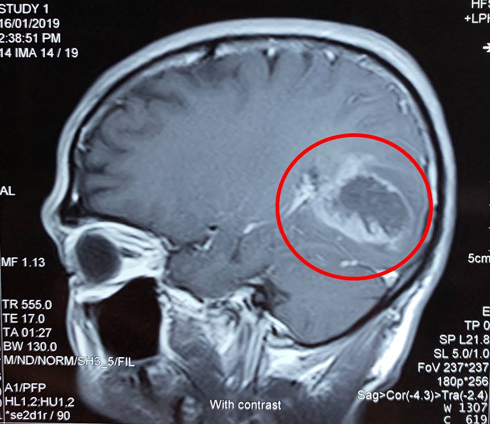 Hình chụp MRI khối u não của bệnh nhân