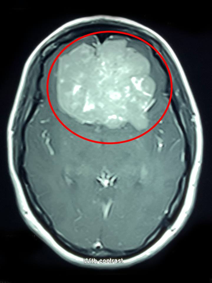 Ảnh chụp cộng hưởng từ (MRI 1.5 Tesla) khối u não của bệnh nhân có kích thước lớn.