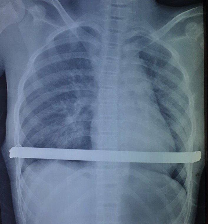 Ảnh chụp X - quang bệnh nhi sau phẫu thuật nâng ngực lõm