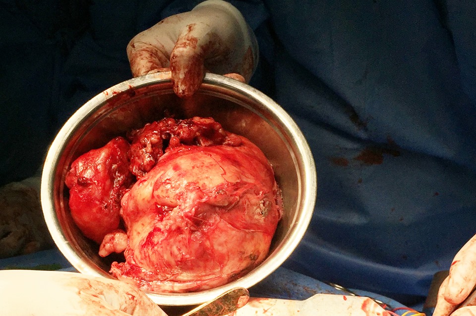 Ảnh khối u được cắt toàn bộ ra khỏi lồng ngực.