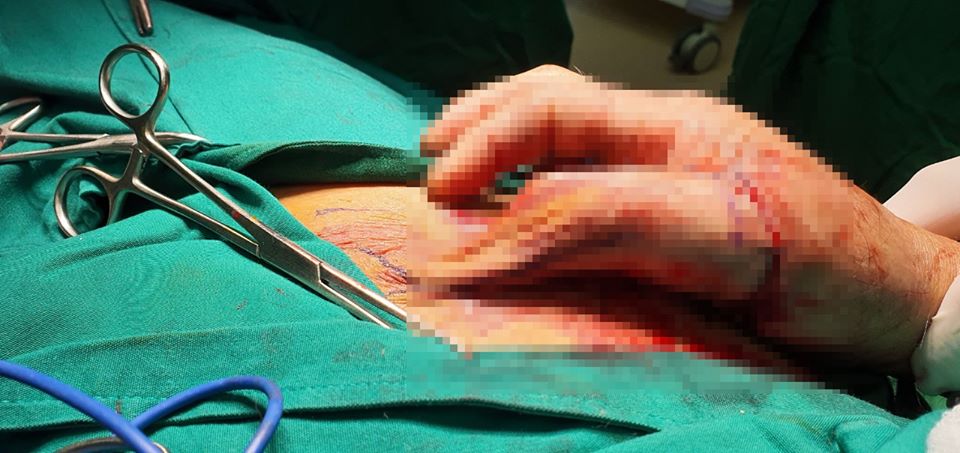 Ngón cái tay phải của bệnh nhân vừa được tạo hình bằng da vùng bẹn.