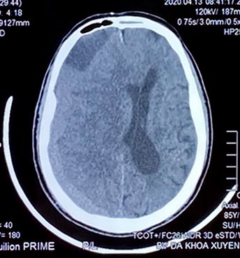 Ảnh CT não - bệnh nhân bị thương tổn xuất huyết tụ máu dưới màng cứng bán cấp bán cầu bên phải, gây chèn ép nhu mô não kế cận, làm lệch cấu trúc đường giữa sang trái.